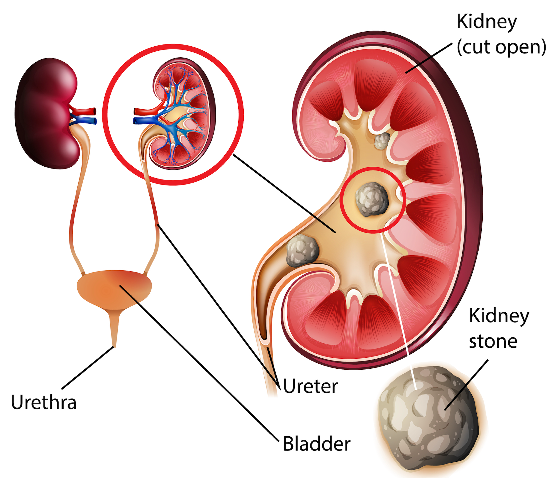 myths-about-diet-and-kidney-stones-osteopaths-have-to-know