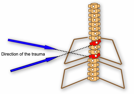 Osteopathy: shift lesion in the upper thoracics