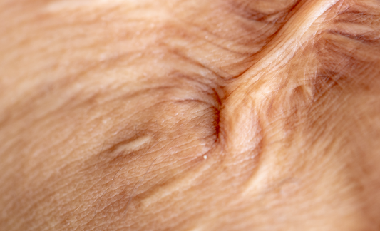 Osteopathy: Complex regional pain syndrome