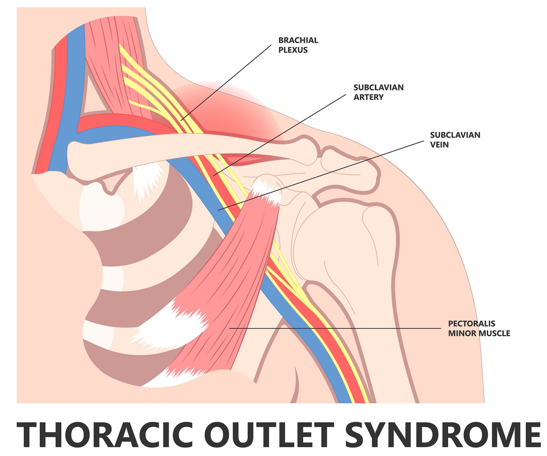 Osteopathic treatment of the thoracic outlet syndrome