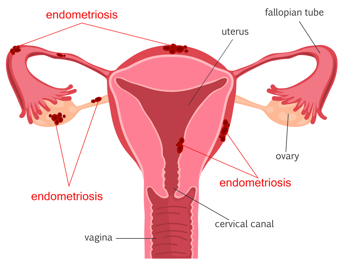 Can osteopathy cure endometriosis?