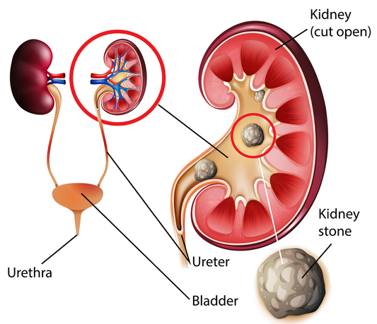 Myths about kidney stones osteopaths have to know