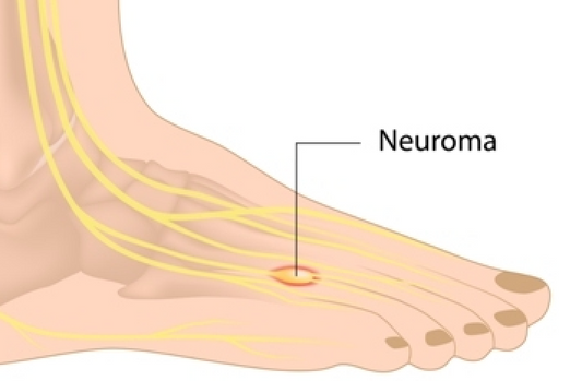 Osteopathy: neuromas