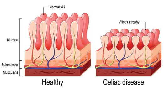 Osteopathy: Celiac disease