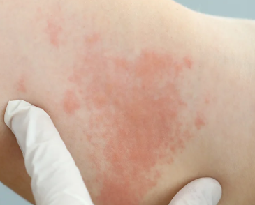 Osteopathy: the meaning of Hives
