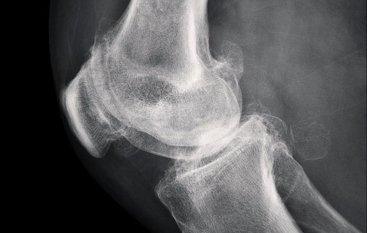 Osteopathy: facts on osteoarthritis