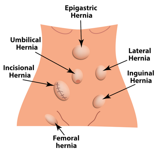 Osteopathy: sports hernia