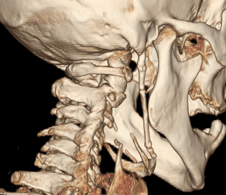 Eagle Syndrome (Stylohyoid Syndrome) Osteopathybooks